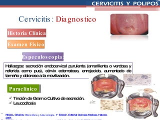 Cervicitis:   Diagnostico Hallazgos: secreción endocervical purulenta (amarillenta o verdosa y referida como pus), cérvix edematoso, enrojecido, aumentado de tamaño y doloroso a la movilización.  Tinción de Gram o Cultivo de secreción.  Leucocitosis Paraclínico RIGOL, Orlando.  Obstetricia y Ginecología.  1° Edición. Editorial Ciencias Medicas. Habana 2004 BEREK, Jonathan.  Ginecología  de Novak.  14ª Edición. Editorial WOLTERS KLUWER. España 2007 Tricomoniasis vaginal  Especuloscopia: Historia Clínica Examen Físico 