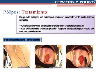 Pólipos:  Tratamiento Polipectomia con Tonsilotomo Se puede extirpar los pólipos durante un procedimiento ambulatorio sencillo.  Un pólipo cervical se puede extirpar con una torsión suave.  Los pólipos más grandes pueden requerir extirpación por medio de electrocauterización. 