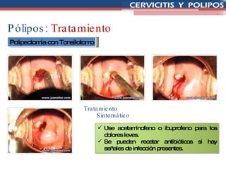 Pólipos:  Tratamiento Polipectomia con Tonsilotomo Tratamiento Sintomático Use acetaminofeno o ibuprofeno para los dolores leves. Se pueden recetar antibióticos si hay señales de infección presentes. 