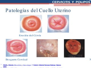 Patologías del Cuello Uterino RIGOL, Orlando.  Obstetricia y Ginecología.  1° Edición. Editorial Ciencias Medicas. Habana 2004 COTRAN y COLLINS.  Anatomía Patológica Robbins.  6° Edición.  McGraw Hill. España 2000. Erosión del Cérvix Desgarro Cervical Quistes de Naboth NIC I Carcinoma Epidermoide 