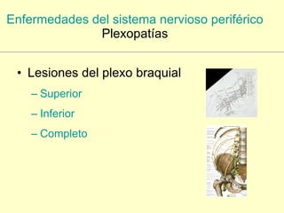 Enfermedades del sistema nervioso periférico Plexopatías Lesiones del plexo braquial Superior Inferior Completo 