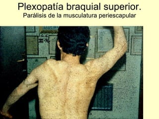 Plexopatía braquial superior.  Parálisis de la musculatura periescapular 