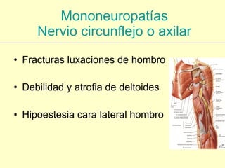 Mononeuropatías Nervio circunflejo o  axilar Fracturas luxaciones de hombro Debilidad y atrofia de deltoides Hipoestesia cara lateral hombro 