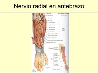 Nervio radial en antebrazo 