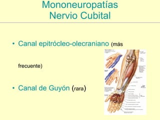 Mononeuropatías Nervio Cubital <ul><li>Canal  epitrócleo - olecraniano   (más frecuente) </li></ul><ul><li>Canal de  Guyón...