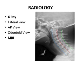RADIOLOGY
• X Ray
• Lateral view
• AP View
• Odontoid View
• MRI
 