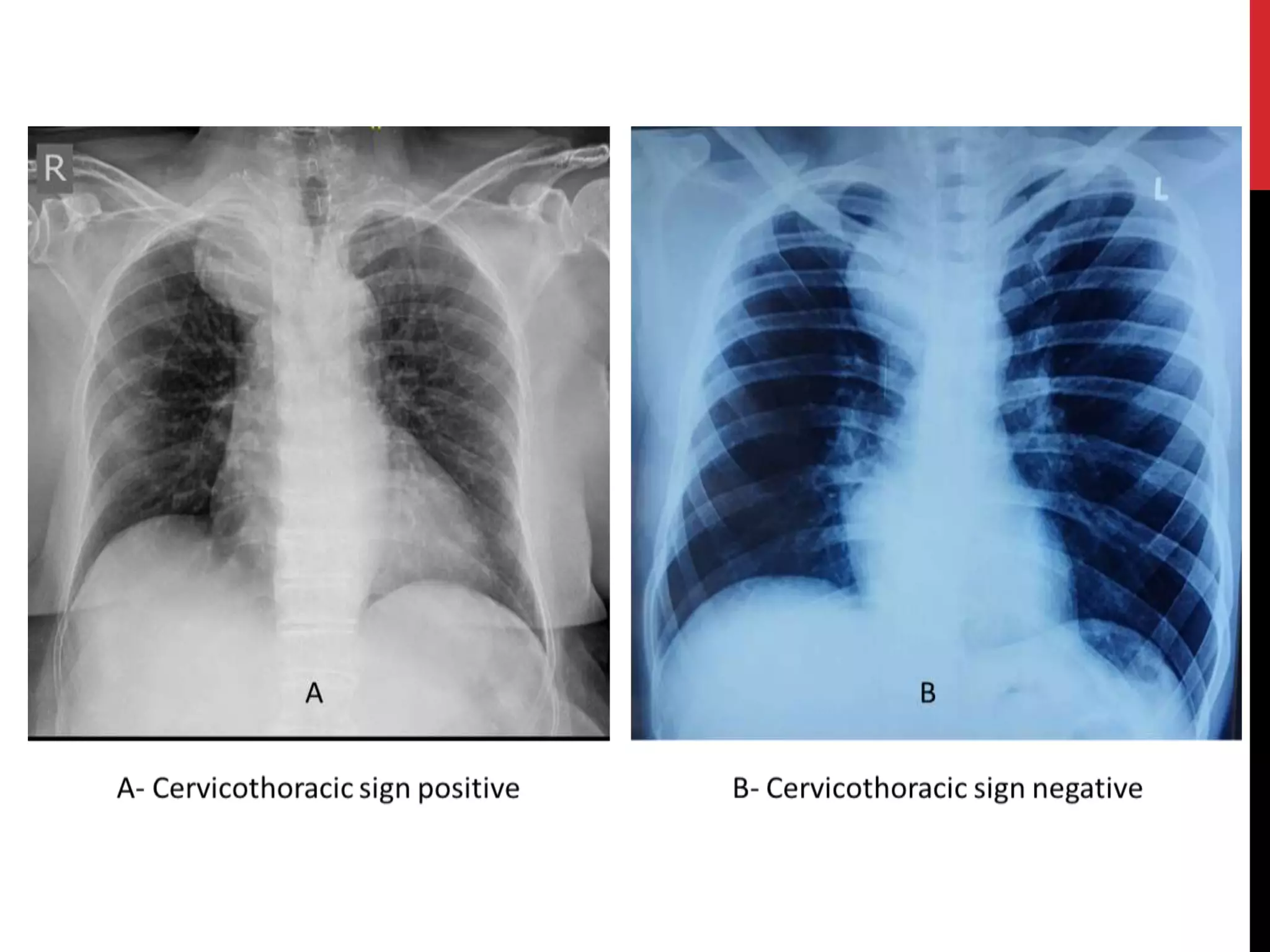 Stuart Sign Cervical Cervicothoracic sign.pptx
