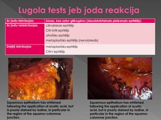 Ar jodu iekrāsojas šūnas, kas satur glikogēnu (daudzkārtainais plakanais epitēlijs)
Ar jodu neiekrāsojas cilindriskais epitēlijs
CIN II/III epitēlijs
atrofisks epitēlijs
metaplastisks epitēlijs (nenobriedis)
Daļēji iekrāsojas metaplastisks epitēlijs
CIN I epitēlijs
Squamous epithelium has whitened
following the application of acetic acid, but
is poorly stained by iodine, in particular in
the region of the squamo-columnar
junction.
Squamous epithelium has whitened
following the application of acetic
acid, but is poorly stained by iodine, in
particular in the region of the squamo-
columnar junction.
 