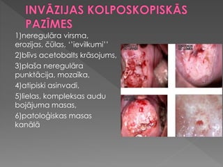 1)neregulāra virsma,
erozijas, čūlas, ‘’ievilkumi’’
2)blīvs acetobalts krāsojums,
3)plaša neregulāra
punktācija, mozaīka,
4)atipiski asinvadi,
5)lielas, kompleksas audu
bojājuma masas,
6)patoloģiskas masas
kanālā
 