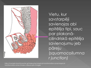 http://mortakis.hpvinfocenter.gr/index.php/atypical-transformation-zone/atypical-
transformation-zone-2-basic-colposcopic-images
Vietu, kur
savstarpēji
savienojas abi
epitēlija tipi, sauc
par plakanā-
cilindriskā epitēlija
savienojumu jeb
pāreju
(squamocollumna
r junction)
 