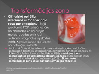 Maksts skābās vides ietekmē, kuru rada estrogēnu veicināta
pienskābo baktēriju savairošanās, ectropion cilindrisko epitēliju ar
laiku sāk aizvietot jauns cilindrisks epitēlijs - veidojas jauns
metaplastisks daudzkārtains plakans epitēlijs, kurā aug arī jauni
asinsvadi, - notiek skvamozā metaplāzija. Skvamozās
metalpāzijas zonu sauc par transformācijas zonu (TZ)
• Cilindriskā epitēlija
izvēršanos ectocervix daļā
sauc par ektropionu - šajā
gadījumā PCP izvirzās uz āru
no dzemdes kakla ārējās
mutes robežas un ir labi
redzama vaginālas apskates
laikā. Agrāk ectropion tika uzskatīts
par patoloģiju un ārstēts.
http://www.brooksidepress.org/Products/Military_OBGYN/Textbook/Pap/Ect
ropion.jpg
 