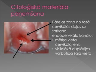 Pārejas zona no rozā
cervikālās daļas uz
sarkano
endocervikālo kanālu:
• mērķa vieta
cervikālajiem;
• vislielākā displāzijas
varbūtība šajā vietā
 