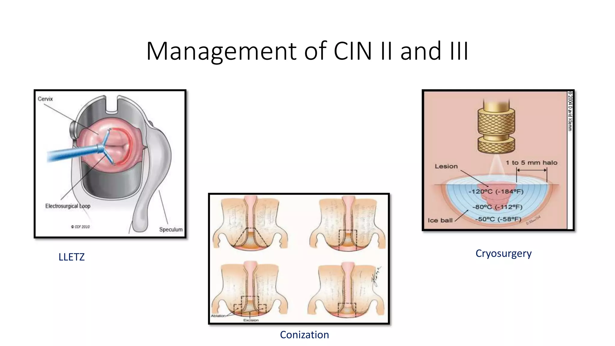 Managment of Cervical Cancer | PPTX