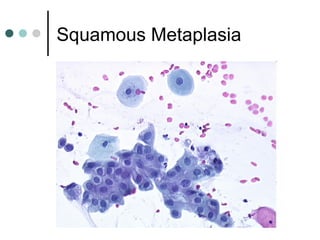 Squamous Metaplasia
 
