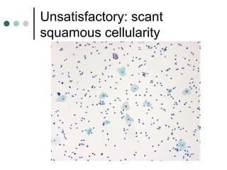 Unsatisfactory: scant
squamous cellularity
 