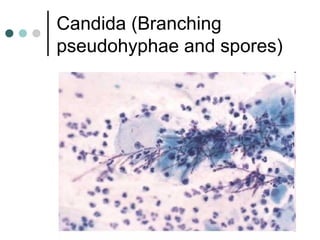 Candida (Branching
pseudohyphae and spores)
 