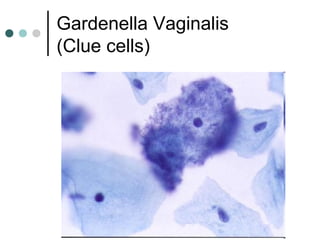 Gardenella Vaginalis
(Clue cells)
 