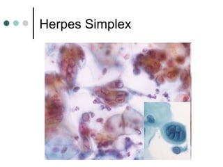 Herpes Simplex
 
