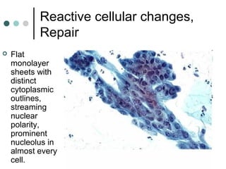 Reactive cellular changes,
Repair
 Flat
monolayer
sheets with
distinct
cytoplasmic
outlines,
streaming
nuclear
polarity,
prominent
nucleolus in
almost every
cell.
 