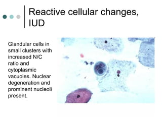 Reactive cellular changes,
IUD
Glandular cells in
small clusters with
increased N/C
ratio and
cytoplasmic
vacuoles. Nuclear
degeneration and
prominent nucleoli
present.
 