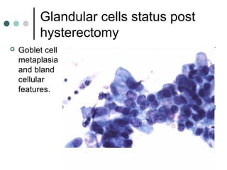 Glandular cells status post
hysterectomy
 Goblet cell
metaplasia
and bland
cellular
features.
 
