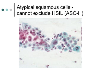 Atypical squamous cells -
cannot exclude HSIL (ASC-H)
 