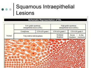 Squamous Intraepithelial
Lesions
 