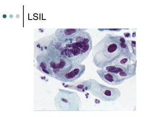 LSIL
 