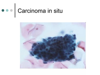 Carcinoma in situ
 