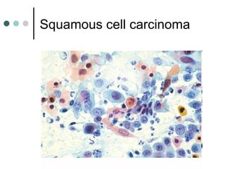 Squamous cell carcinoma
 