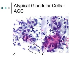 Atypical Glandular Cells -
AGC
 