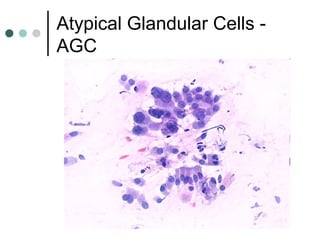 Atypical Glandular Cells -
AGC
 