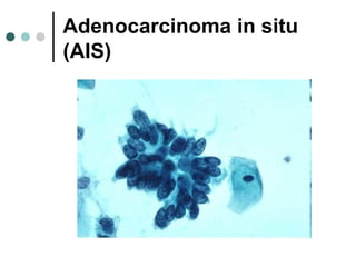 Adenocarcinoma in situ
(AIS)
 