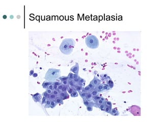 Squamous Metaplasia
 