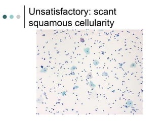 Unsatisfactory: scant
squamous cellularity
 