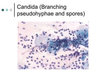 Candida (Branching
pseudohyphae and spores)
 