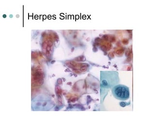 Herpes Simplex
 