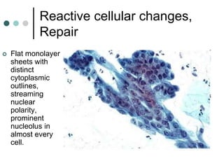 Reactive cellular changes,
Repair
 Flat monolayer
sheets with
distinct
cytoplasmic
outlines,
streaming
nuclear
polarity,
prominent
nucleolus in
almost every
cell.
 