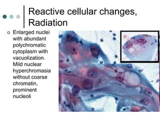 Reactive cellular changes,
Radiation
 Enlarged nuclei
with abundant
polychromatic
cytoplasm with
vacuolization.
Mild nuclear
hyperchromasia
without coarse
chromatin,
prominent
nucleoli
 