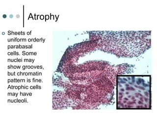 Atrophy
 Sheets of
uniform orderly
parabasal
cells. Some
nuclei may
show grooves,
but chromatin
pattern is fine.
Atrophic cells
may have
nucleoli.
 