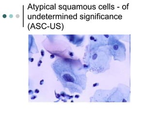 Atypical squamous cells - of
undetermined significance
(ASC-US)
 