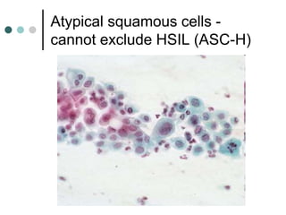 Atypical squamous cells -
cannot exclude HSIL (ASC-H)
 
