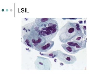 LSIL
 