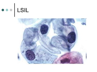 LSIL
 