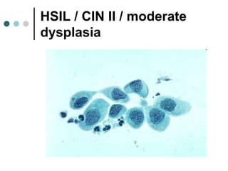 HSIL / CIN II / moderate
dysplasia
 