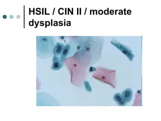 HSIL / CIN II / moderate
dysplasia
 
