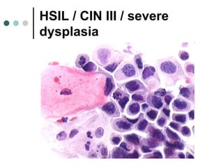 HSIL / CIN III / severe
dysplasia
 