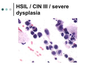 HSIL / CIN III / severe
dysplasia
 