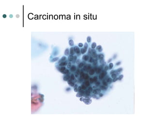 Carcinoma in situ
 