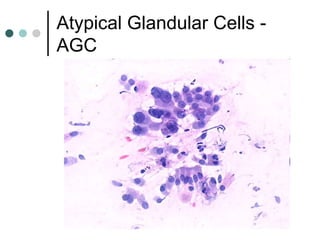 Atypical Glandular Cells -
AGC
 